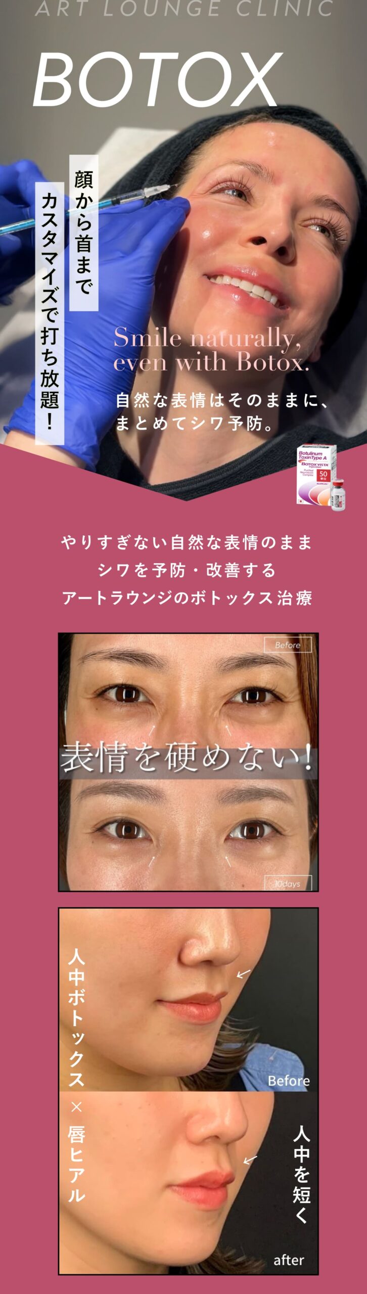 アートラウンジのボトックス