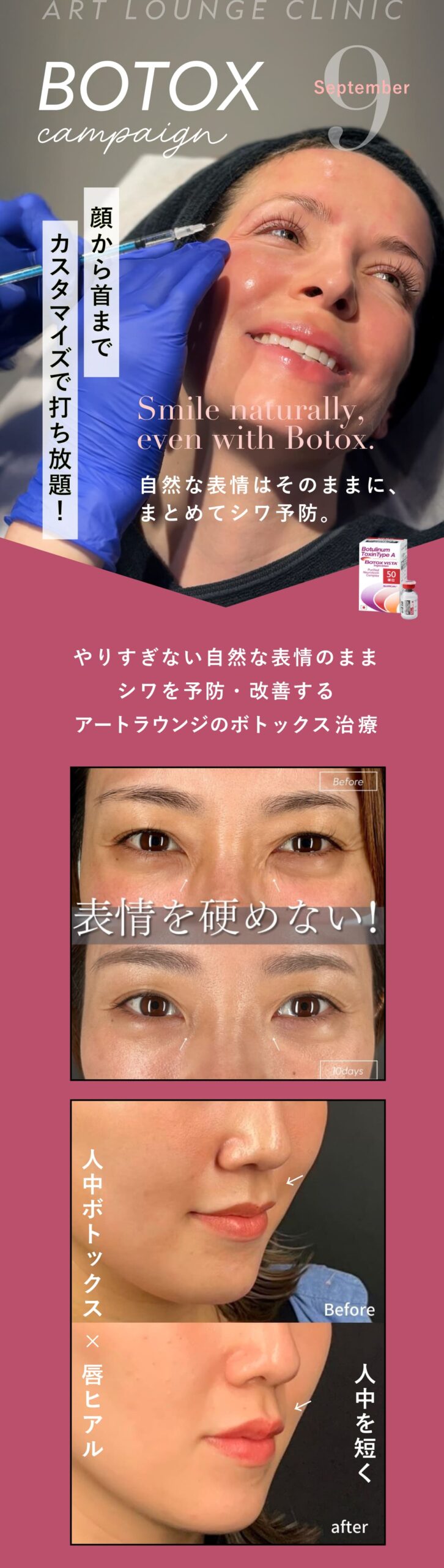 ボトックスキャンペーン