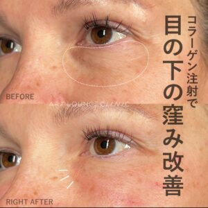 コラーゲン注射(Collagen Injection)