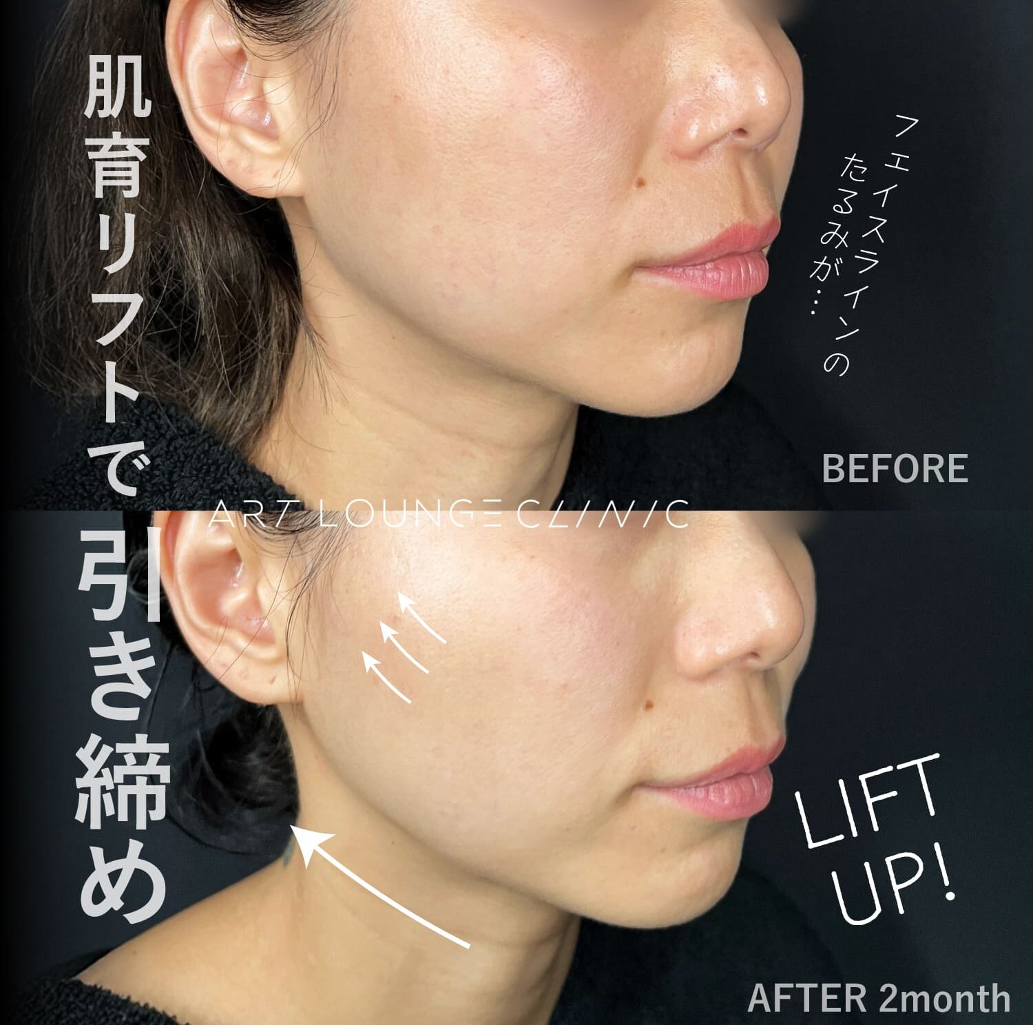 糸リフト(Thread lift）