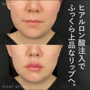 ヒアルロン酸(Filler)