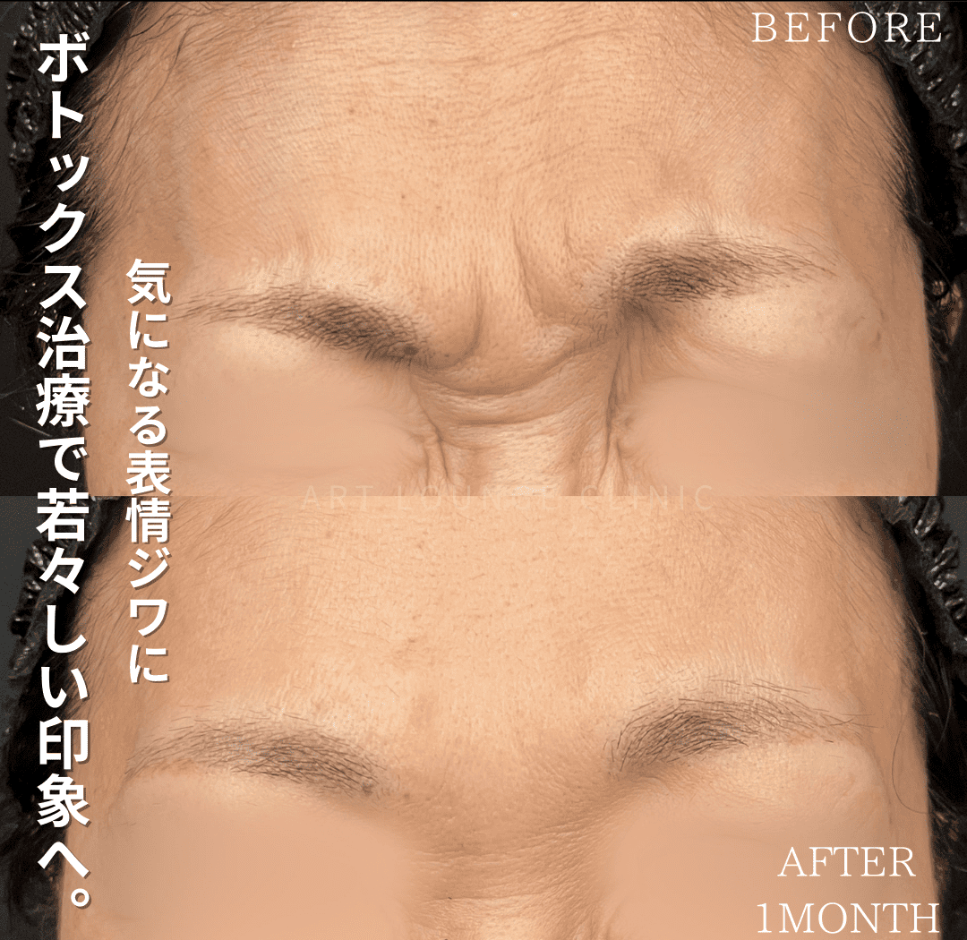 ボトックス(Botox)