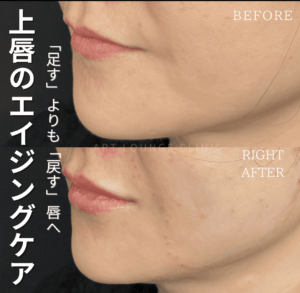 ヒアルロン酸(Filler)