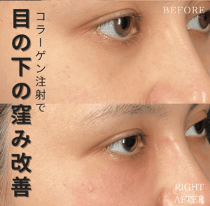 コラーゲン注射(Collagen Injection)