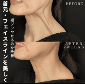 ボトックス(Botox)