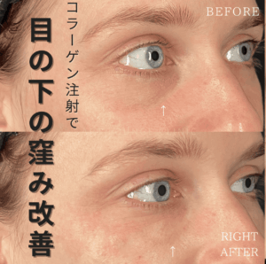 コラーゲン注射(Collagen Injection)