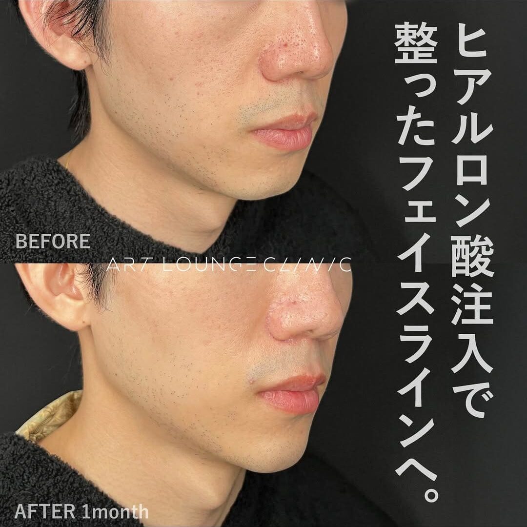 ヒアルロン酸(Filler)