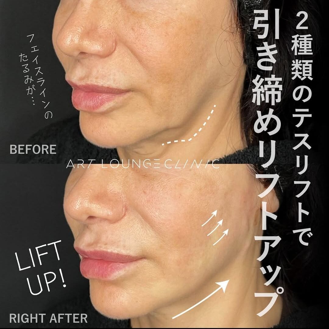 糸リフト(Thread lift）