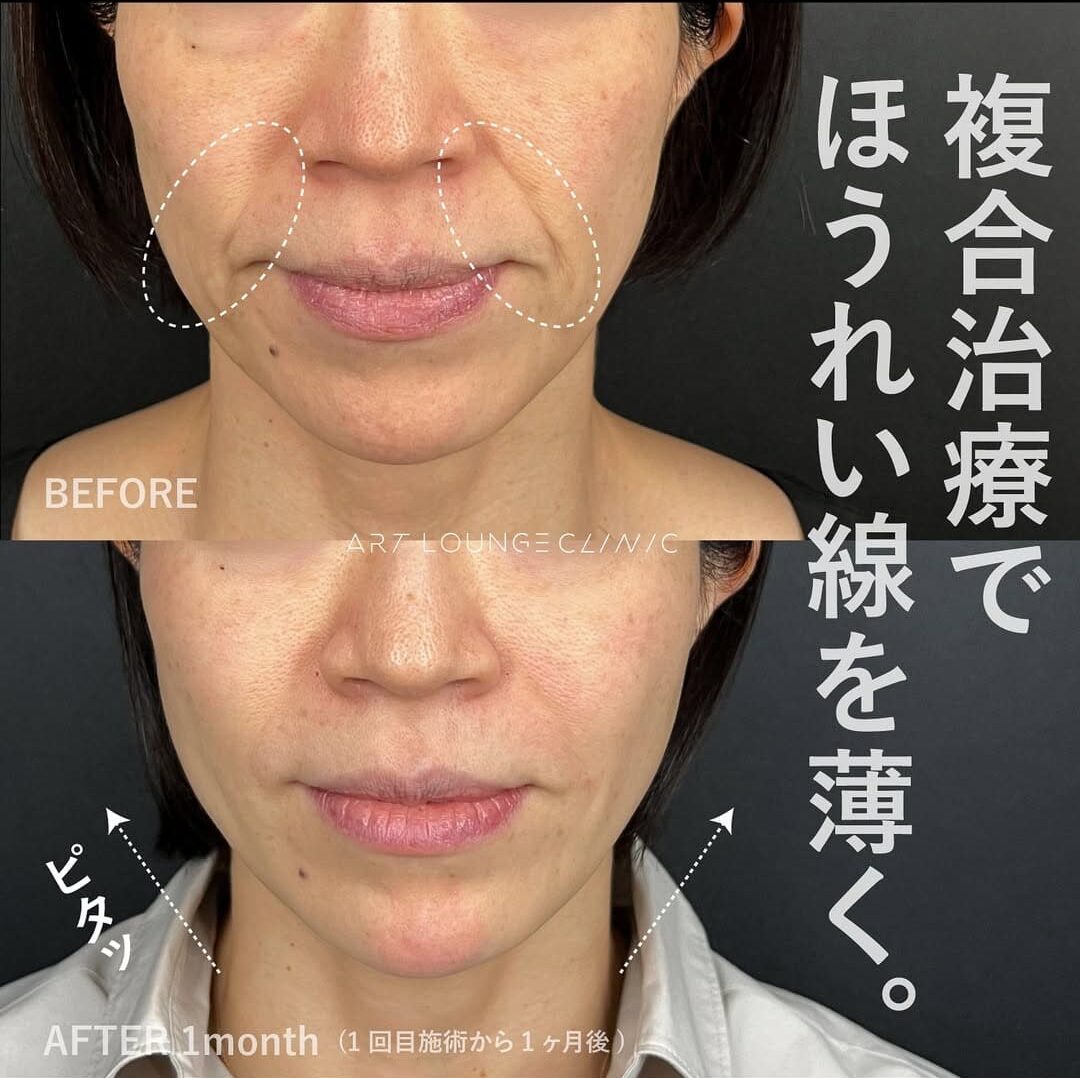 糸リフト×ヒアルロン酸×サーマHIFU(Thread lift×Filler×HIFU＆RF)