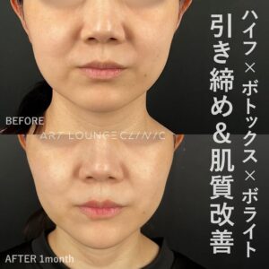 サーマHIFU×ボトックス×ボライト(HIFU＆RF×Botox×Volite)