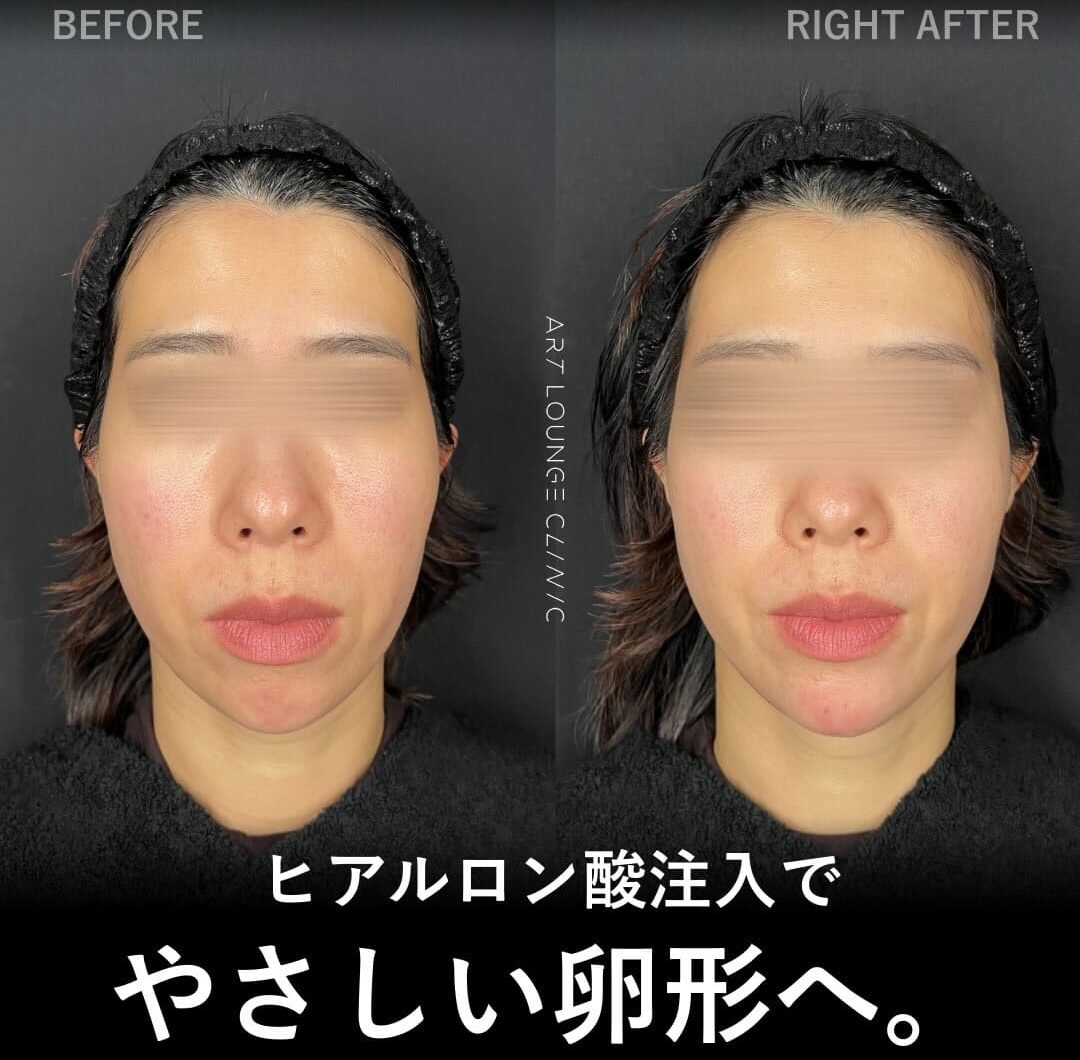 ヒアルロン酸(Filler)