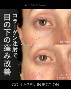 コラーゲン注射(Collagen Injection)
