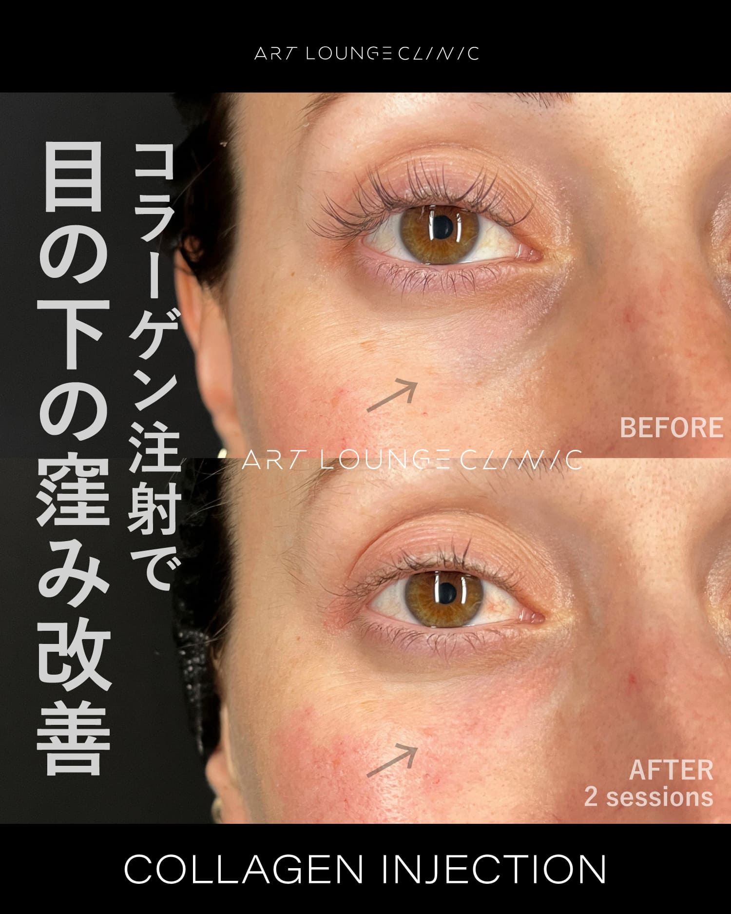 コラーゲン注射(Collagen Injection)
