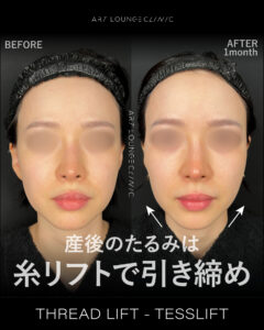 糸リフト(Thread lift）