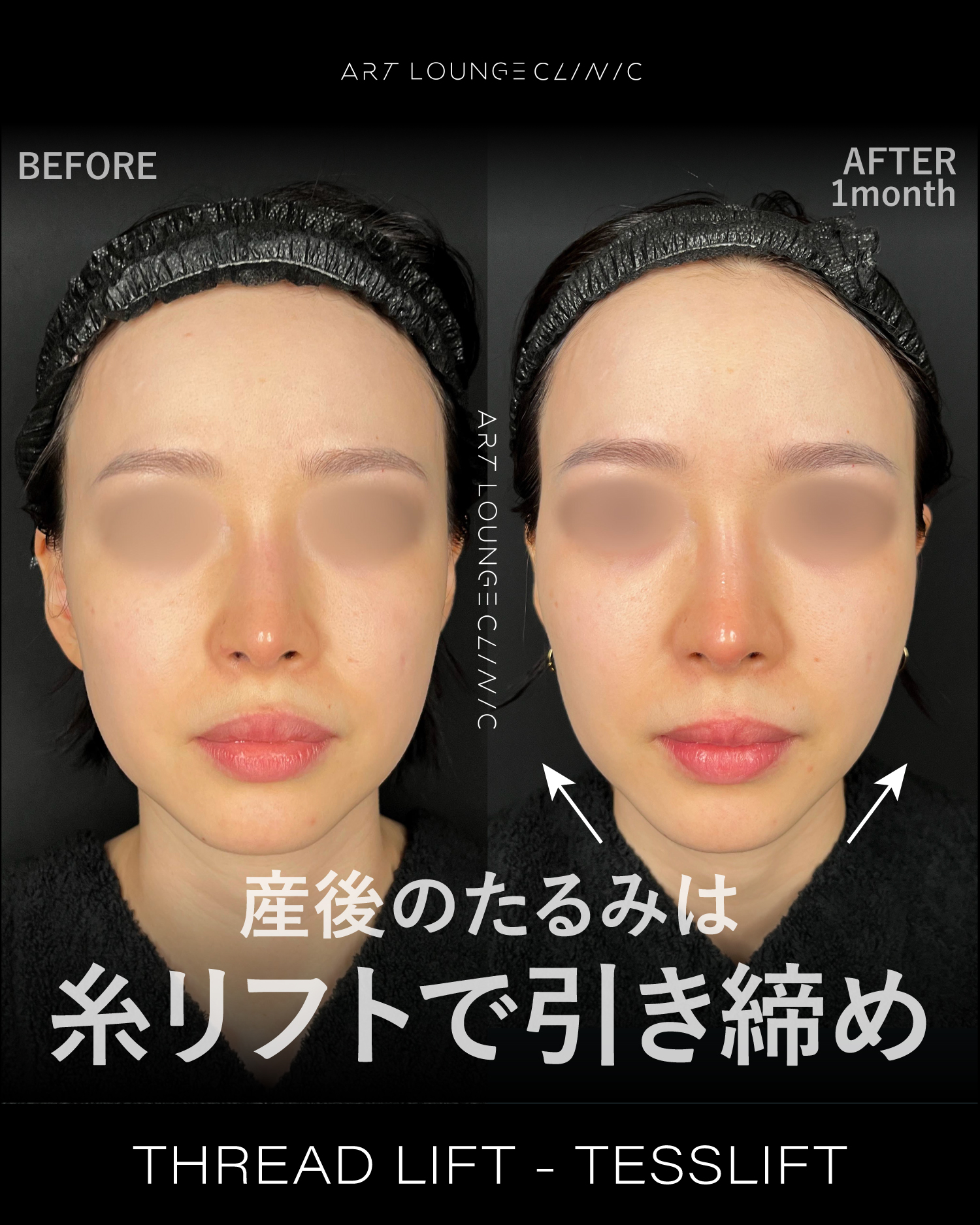 糸リフト(Thread lift）