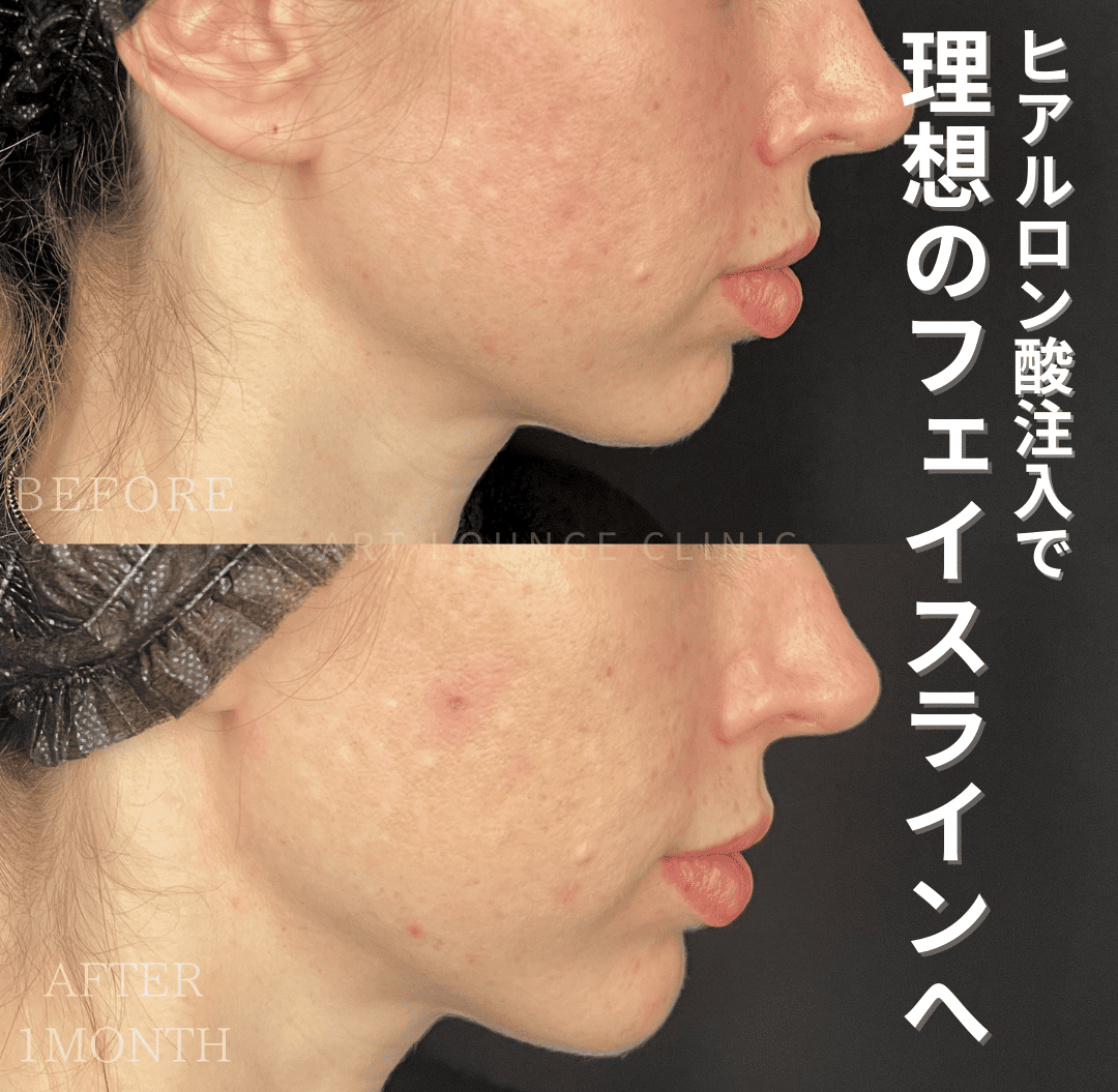 ヒアルロン酸(Filler)