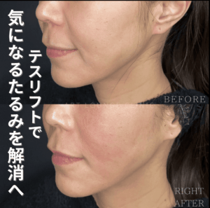 糸リフト(Thread lift）