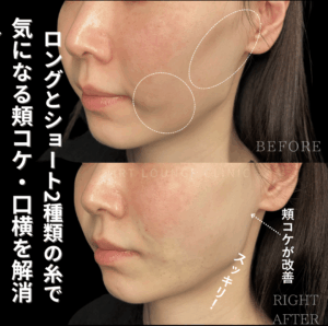 糸リフト(Thread lift）×ショッピングスレッド(Short Thread）