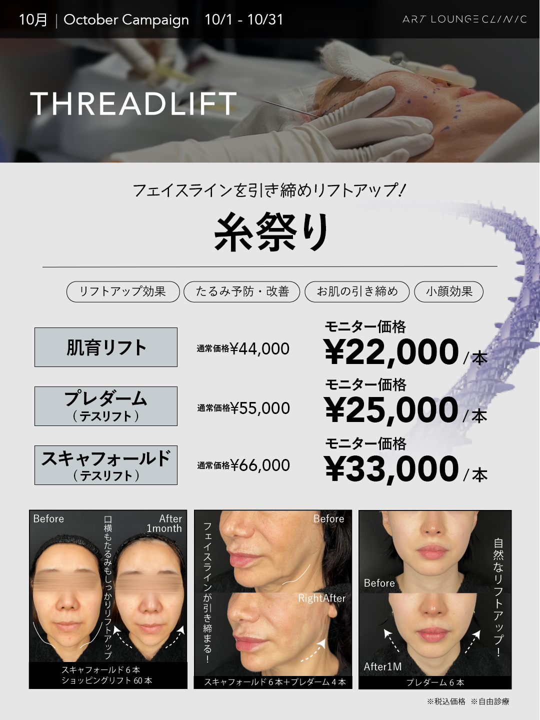 10月キャンペーン 糸祭り 肌育リフト22,000円・プレダーム25,000円・スキャフォールド33,000円（1本あたり・モニター価格・税込）