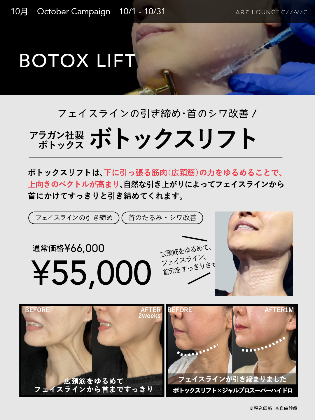 10月キャンペーン ボトックスリフト（アラガン社製ボトックス）55,000円（通常価格66,000円・税込）