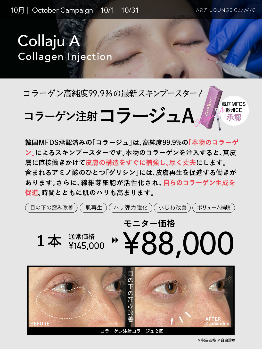 10月キャンペーン コラーゲン注射コラージュA 1本 モニター価格88,000円（通常価格145,000円・税込）