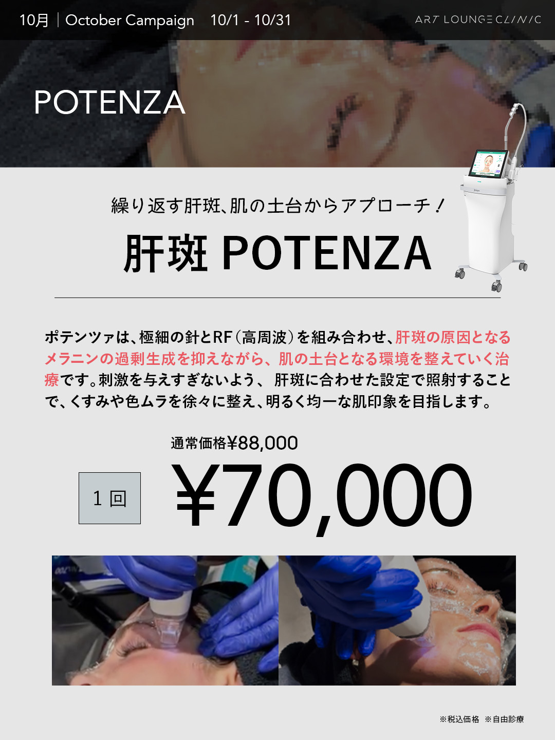 10月キャンペーン 肝斑POTENZA（ポテンツァ）1回70,000円（通常価格88,000円・税込）
